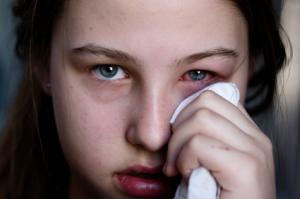 Προσοχή στις αλλεργίες συνιστούν οι οφθαλμίατροι